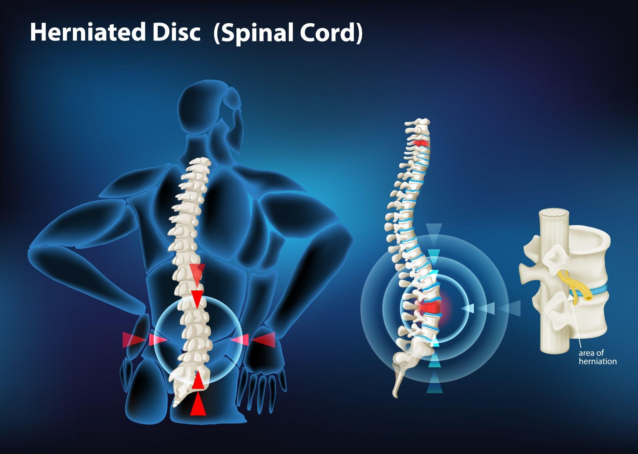 หมอนรองกระดูก คือ